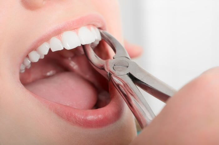 Cabut Gigi Nine Dental